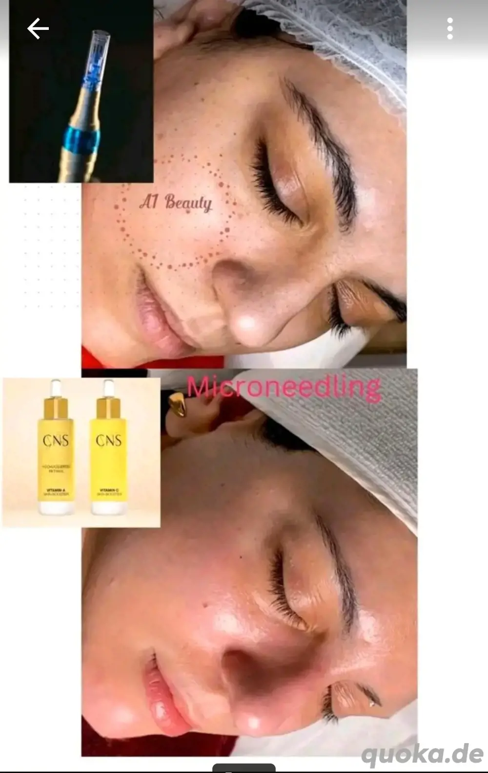 Gesichtsbehandlung Microneedling & Microdermabrasion 