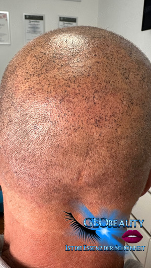 Haarpigmentierung Haarverdichtung