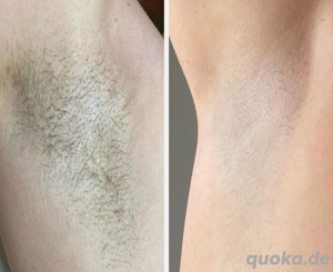 Diodenlaser