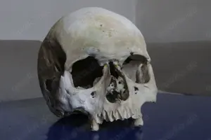 Pathologisches Anschauungsobjekt - menschlicher Schädel
