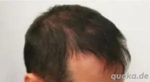 Bezahlbare Haartransplantation