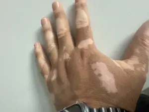 Freundin gesucht wie ich Hat sie Pigment Flecken hat sie 