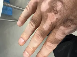 Lust auf eine affäre, fremde haut? Gesucht wie ich Körperlich Pigment Flecken Frau 