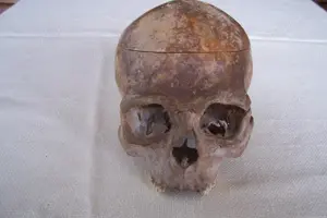 Menschlicher Pathologischer Schädel Antik
