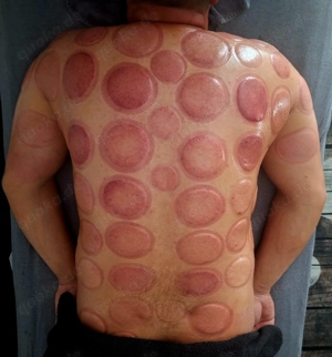 Schröpfen  Massage - gegen Verspannungen, Schmerzen, Stoffwechsel, Faszie & Energie - Körper & Geis Bild 3