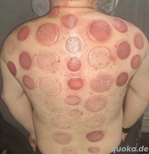 Schröpfen  Massage - gegen Verspannungen, Schmerzen, Stoffwechsel, Faszie & Energie - Körper & Geis Bild 8