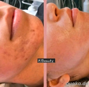 Gesichtsbehandlung  Pigmentflecken Hautverjüngung 