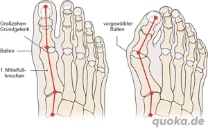 Hallux Valgus gezielt entlasten   ohne Operation. Keine sexuellen od. erotischen Dienstleistungen