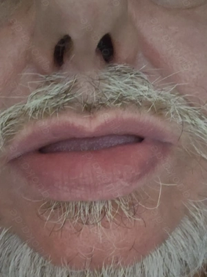 Blasemaul und NS Maul