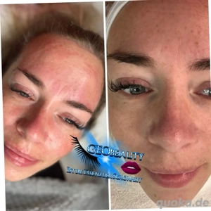 Aqua Facial Gesichtsbehandlung Hydrafacial