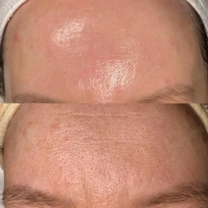 Microneedling Behandlung - Anti-Aging & Hautstraffung Bild 4