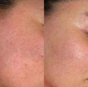 Microneedling Behandlung - Anti-Aging & Hautstraffung Bild 2