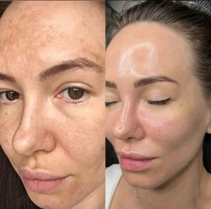 Microneedling Behandlung - Anti-Aging & Hautstraffung