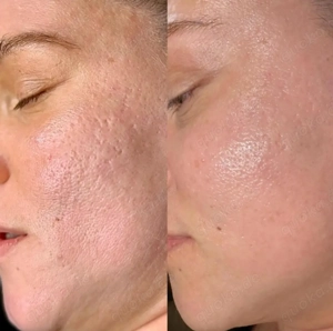 Microneedling Behandlung - Anti-Aging & Hautstraffung Bild 3