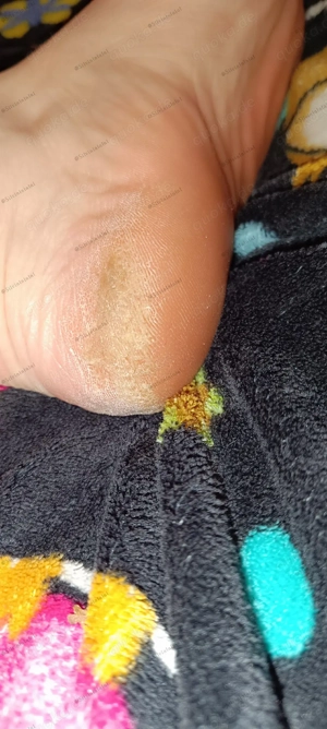 Hornhaut, trockene Füße 