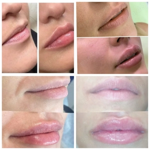 Lippenvolumen mit Hyaluron Pen