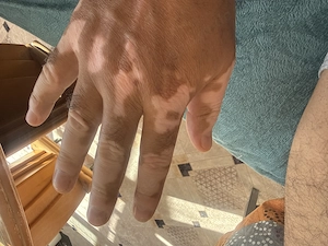 Pigment flecken Mann suche Frau 