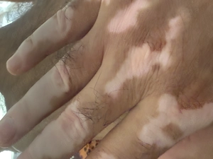 Suche Frau für erotische Treffen mit Pigment Störung an körperliche 