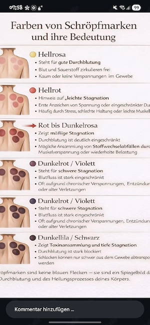   Hijama | Traditionelles Schröpfen | Hagen & Umgebung Bild 4